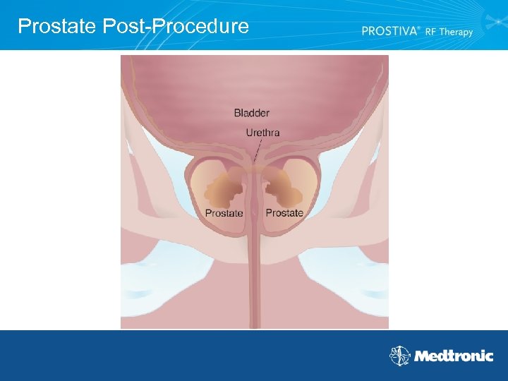 Prostate Post-Procedure 