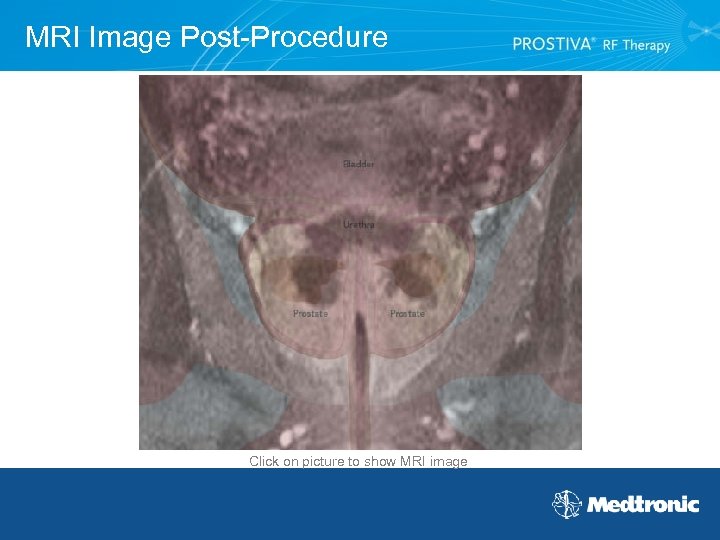 MRI Image Post-Procedure Click on picture to show MRI image 