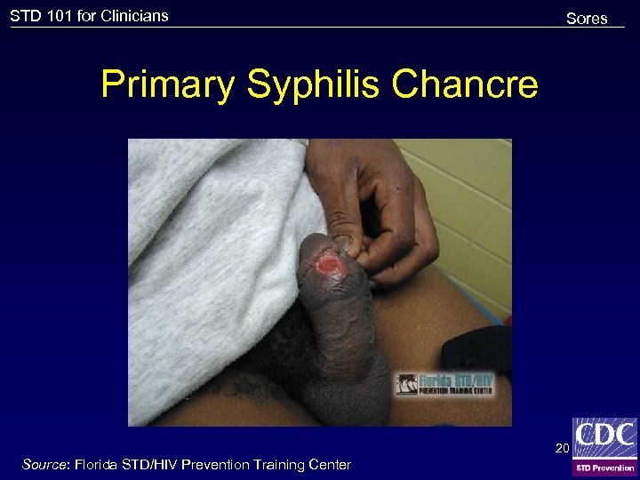 STD 101 for Clinicians Sores Primary Syphilis Chancre 20 Source: Florida STD/HIV Prevention Training