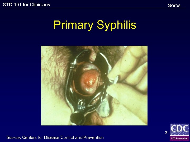 STD 101 for Clinicians Sores Primary Syphilis 21 Source: Centers for Disease Control and