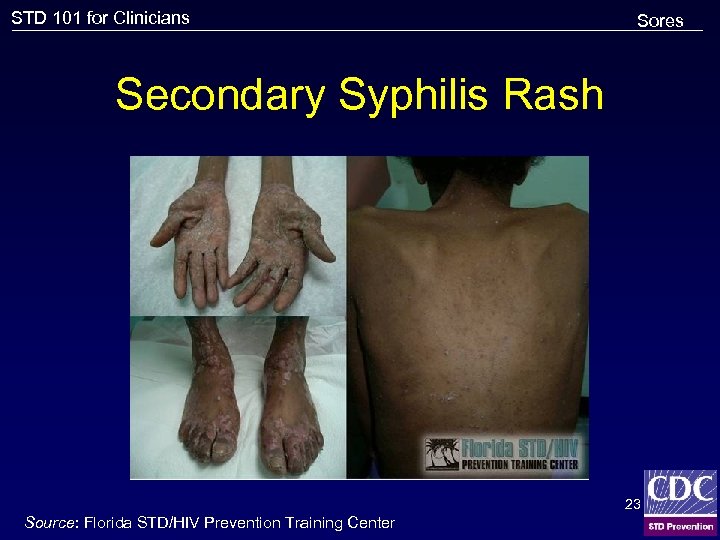 STD 101 for Clinicians Sores Secondary Syphilis Rash 23 Source: Florida STD/HIV Prevention Training