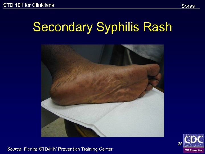 STD 101 for Clinicians Sores Secondary Syphilis Rash 25 Source: Florida STD/HIV Prevention Training