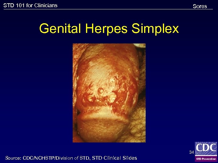 STD 101 for Clinicians Sores Genital Herpes Simplex 34 Source: CDC/NCHSTP/Division of STD, STD