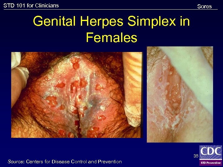 STD 101 for Clinicians Sores Genital Herpes Simplex in Females 35 Source: Centers for