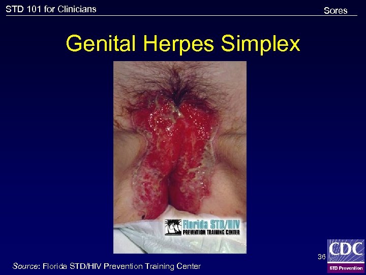 STD 101 for Clinicians Sores Genital Herpes Simplex 36 Source: Florida STD/HIV Prevention Training