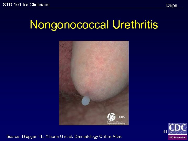 STD 101 for Clinicians Drips Nongonococcal Urethritis 41 Source: Diepgen TL, Yihune G et