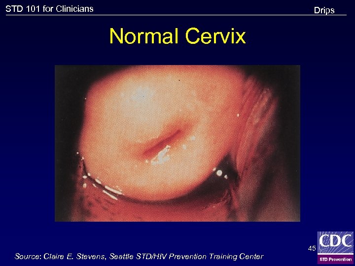 STD 101 for Clinicians Drips Normal Cervix Source: Claire E. Stevens, Seattle STD/HIV Prevention