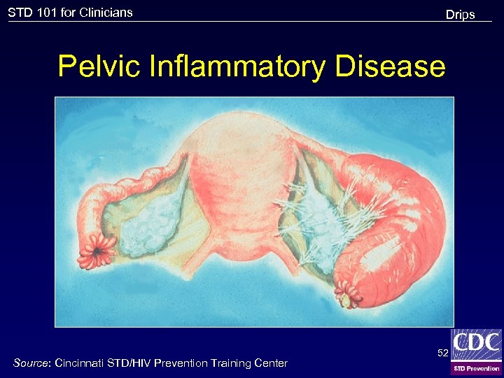 STD 101 for Clinicians Drips Pelvic Inflammatory Disease Source: Cincinnati STD/HIV Prevention Training Center