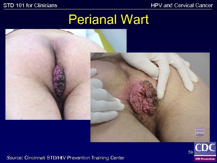 HPV and Cervical Cancer STD 101 for Clinicians Perianal Wart 59 Source: Cincinnati STD/HIV