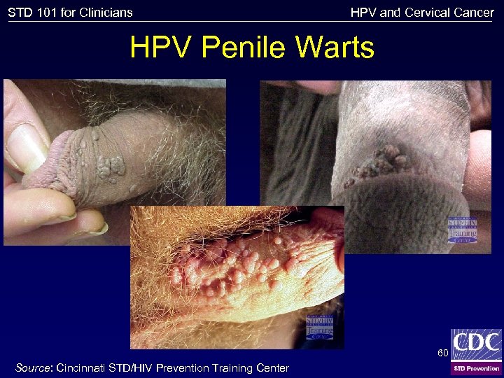 STD 101 for Clinicians HPV and Cervical Cancer HPV Penile Warts 60 Source: Cincinnati