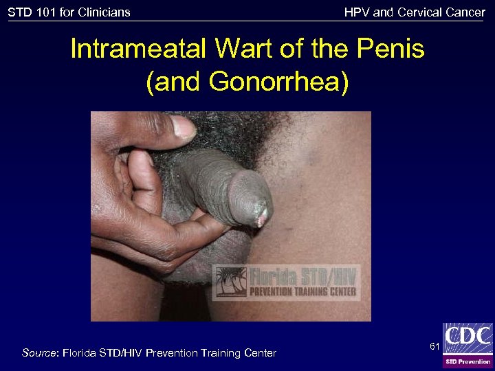 STD 101 for Clinicians HPV and Cervical Cancer Intrameatal Wart of the Penis (and