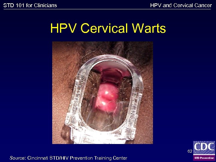 STD 101 for Clinicians HPV and Cervical Cancer HPV Cervical Warts 62 Source: Cincinnati