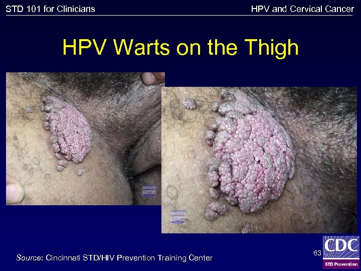 STD 101 for Clinicians HPV and Cervical Cancer HPV Warts on the Thigh Source: