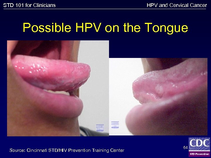 STD 101 for Clinicians HPV and Cervical Cancer Possible HPV on the Tongue Source: