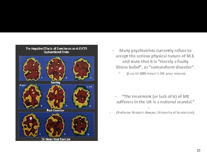  Many psychiatrists currently refuse to accept the serious physical nature of M. E.