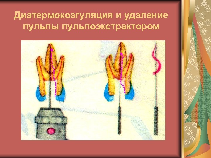 Диатермокоагуляция и удаление пульпы пульпоэкстрактором 