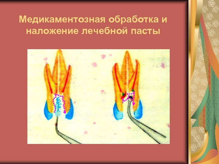 Медикаментозная обработка и наложение лечебной пасты 