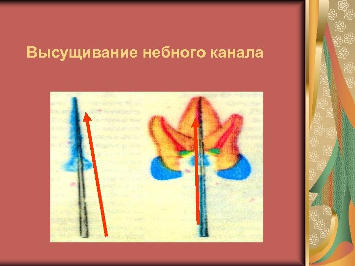 Высущивание небного канала 