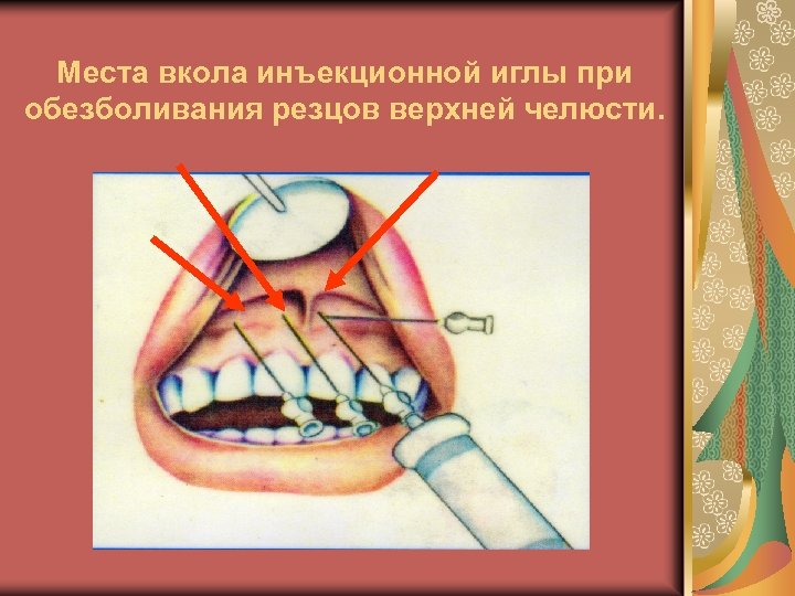 Места вкола инъекционной иглы при обезболивания резцов верхней челюсти. 
