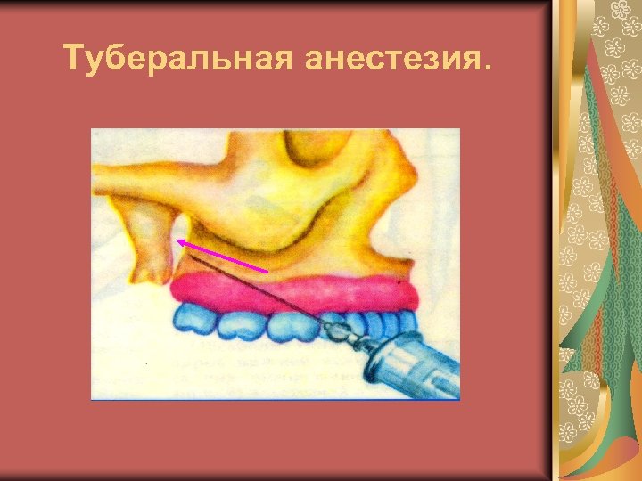 Туберальная анестезия. 