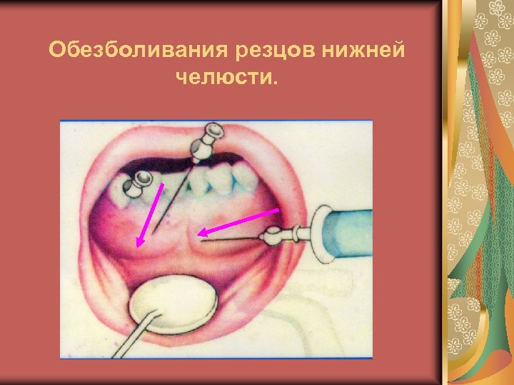 Обезболивания резцов нижней челюсти. 
