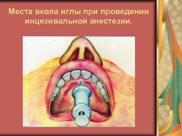 Места вкола иглы при проведении инцезивальной анестезии. 