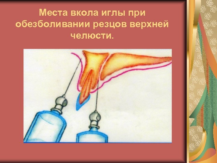 Места вкола иглы при обезболивании резцов верхней челюсти. 