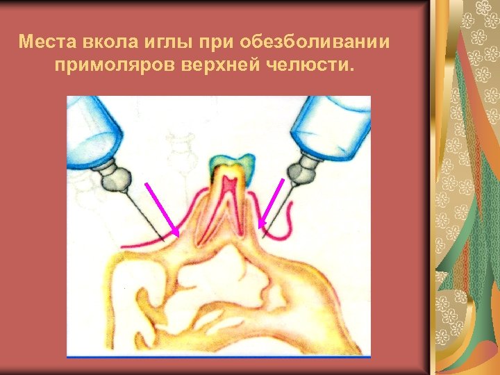 Места вкола иглы при обезболивании примоляров верхней челюсти. 