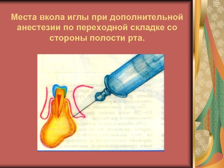 Места вкола иглы при дополнительной анестезии по переходной складке со стороны полости рта. 