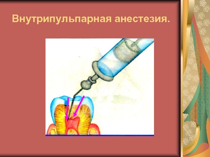 Внутрипульпарная анестезия. 