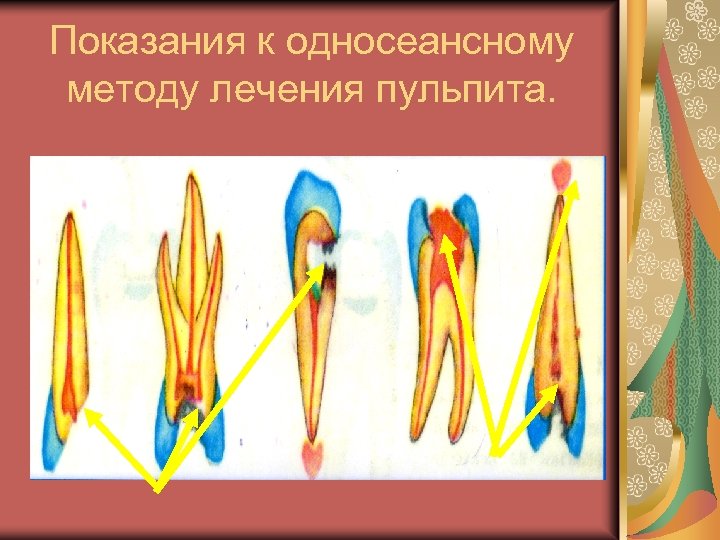 Показания к односеансному методу лечения пульпита. 