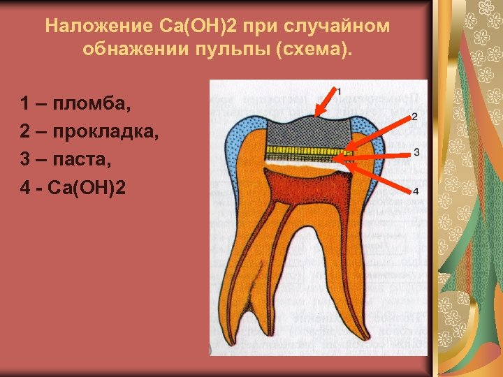 Наложение Ca(OH)2 при случайном обнажении пульпы (схема). 1 – пломба, 2 – прокладка, 3