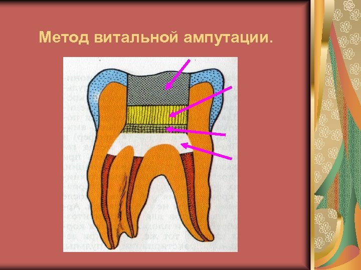 Метод витальной ампутации. 