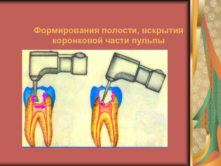 Формирования полости, вскрытия коронковой части пульпы 