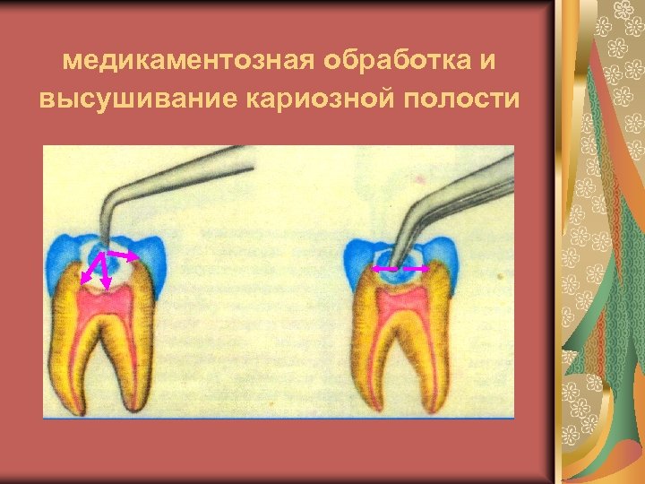 Пломбирование кариозных полостей временных