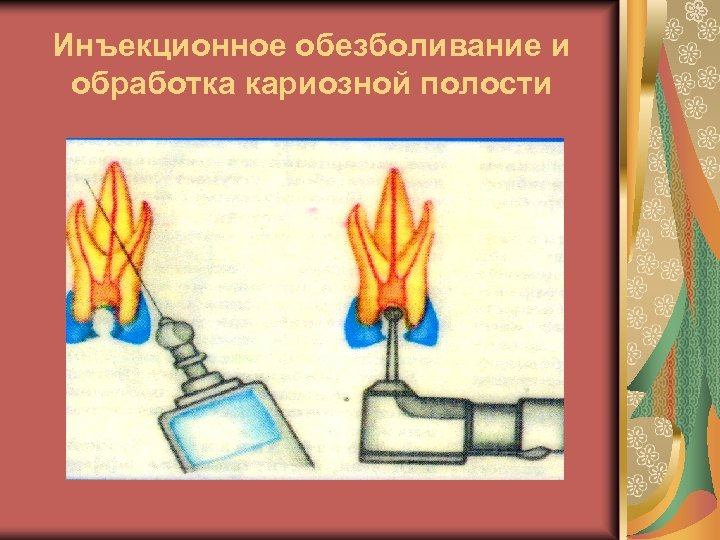 Инъекционное обезболивание и обработка кариозной полости 