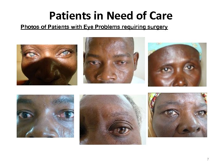 Patients in Need of Care Photos of Patients with Eye Problems requiring surgery 7