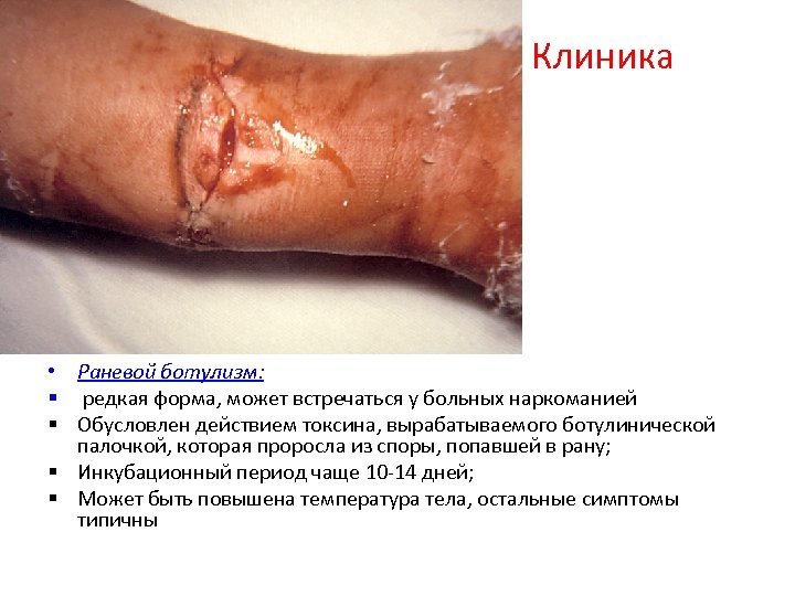 Клиника • Раневой ботулизм: § редкая форма, может встречаться у больных наркоманией § Обусловлен