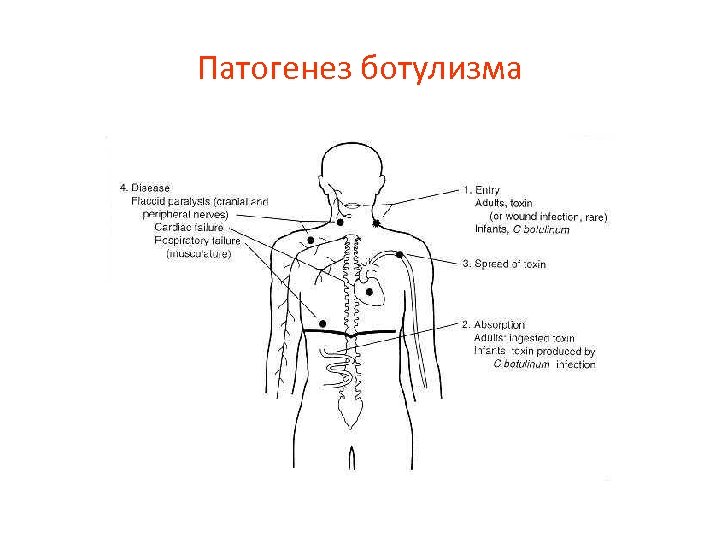 Патогенез ботулизма 