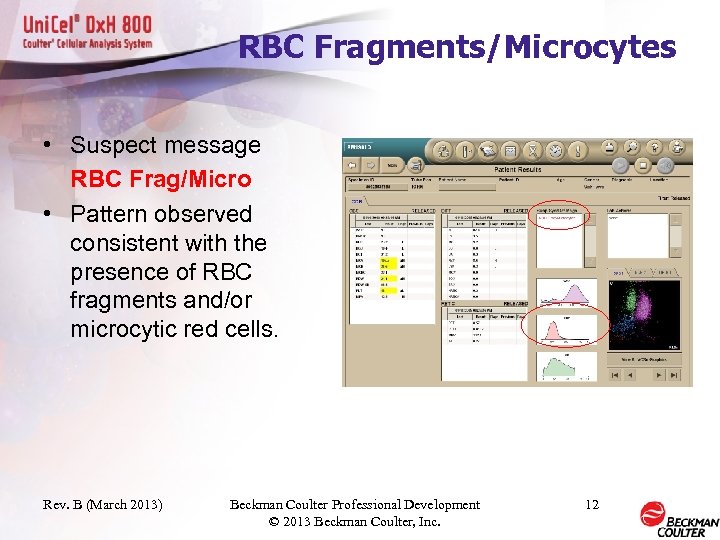 RBC Fragments/Microcytes • Suspect message RBC Frag/Micro • Pattern observed consistent with the presence