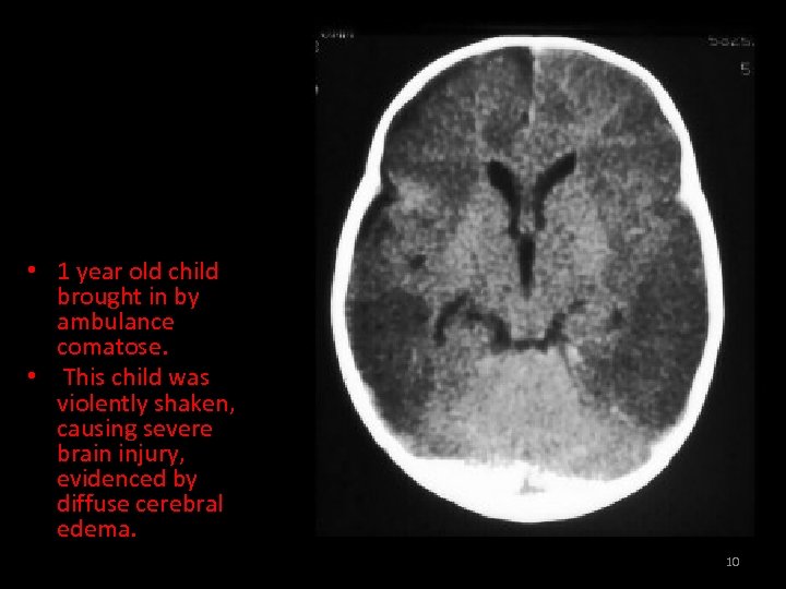  • 1 year old child brought in by ambulance comatose. • This child