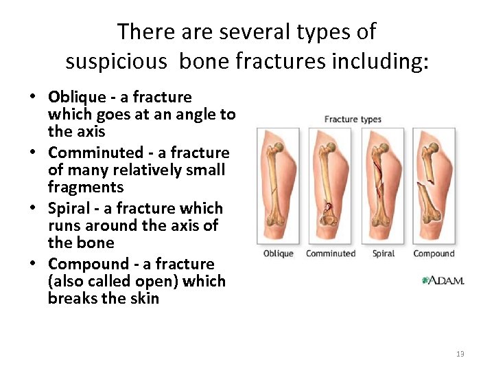 There are several types of suspicious bone fractures including: • Oblique - a fracture