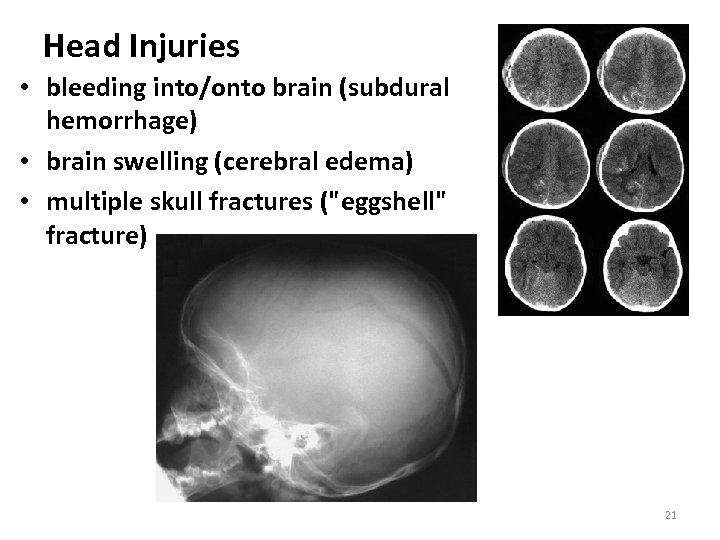Head Injuries • bleeding into/onto brain (subdural hemorrhage) • brain swelling (cerebral edema) •