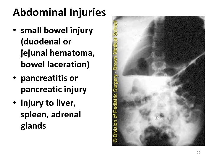 Abdominal Injuries • small bowel injury (duodenal or jejunal hematoma, bowel laceration) • pancreatitis