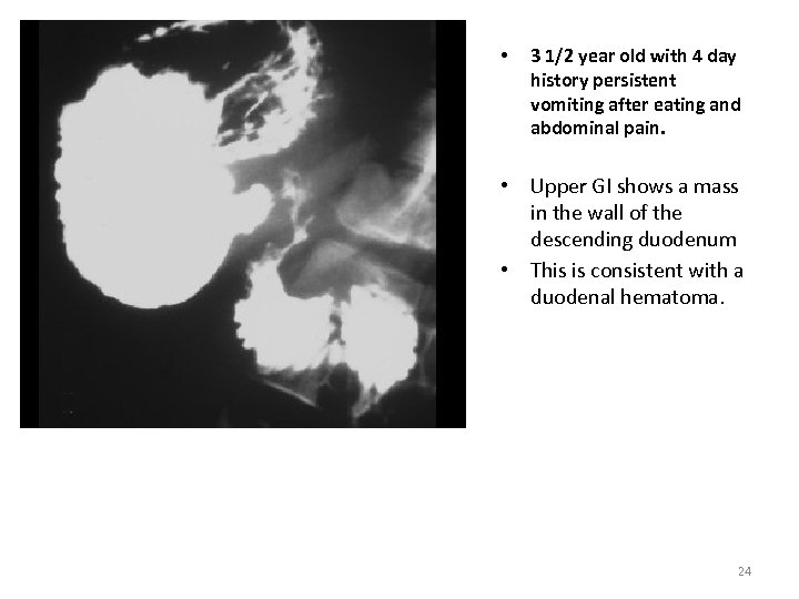  • 3 1/2 year old with 4 day history persistent vomiting after eating