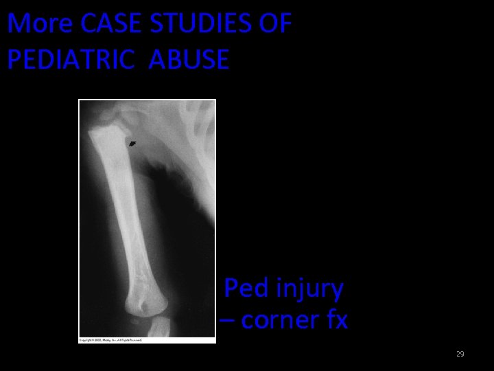More CASE STUDIES OF PEDIATRIC ABUSE Ped injury – corner fx 29 