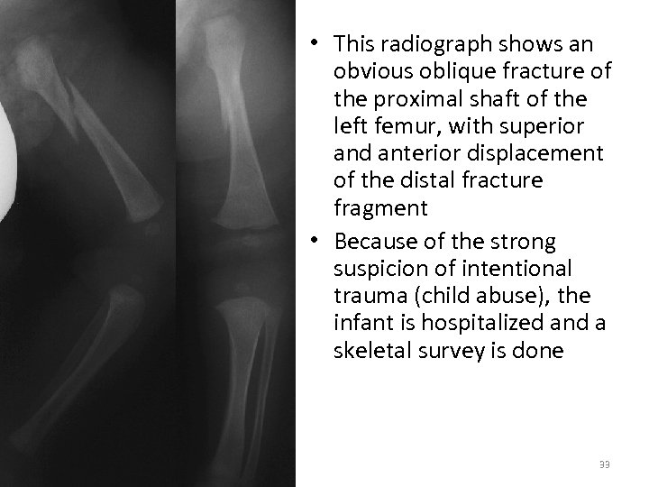  • This radiograph shows an obvious oblique fracture of the proximal shaft of
