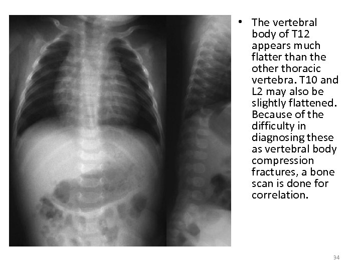  • The vertebral body of T 12 appears much flatter than the other