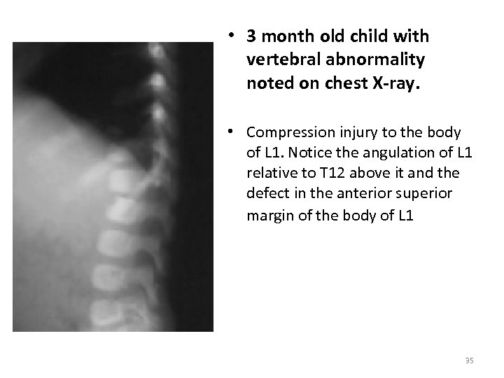 • 3 month old child with vertebral abnormality noted on chest X-ray. •