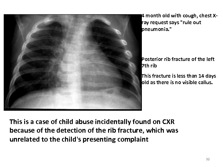 4 month old with cough, chest Xray request says "rule out pneumonia. " Posterior